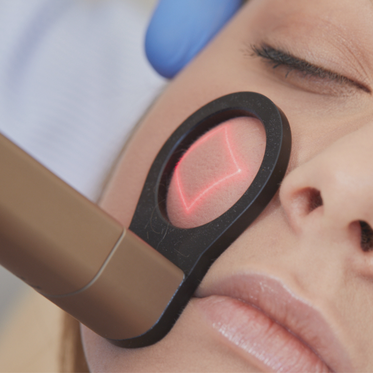 babyface - all treatments - fractional co2 laser